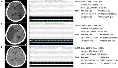 Multimodal Monitoring in Large Hemispheric Infarction: Quantitative Electroencephalography Combined With Transcranial Doppler for Prognosis Prediction